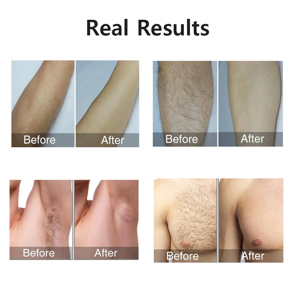 Portable IPL Laser Epilator